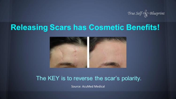 MPS Scar Release Therapy at Olla Terve, Pagosa Springs